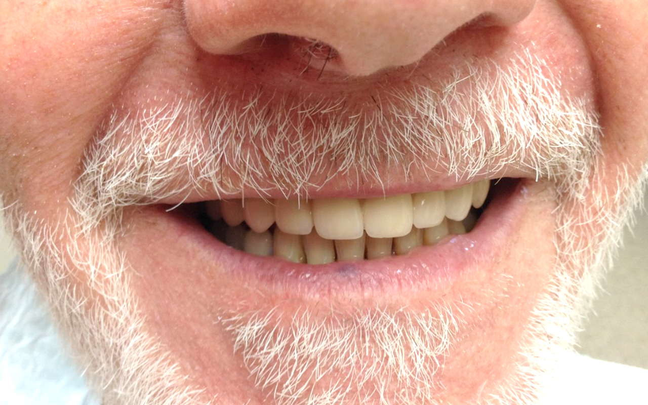 Full-arch restoration - after treatment