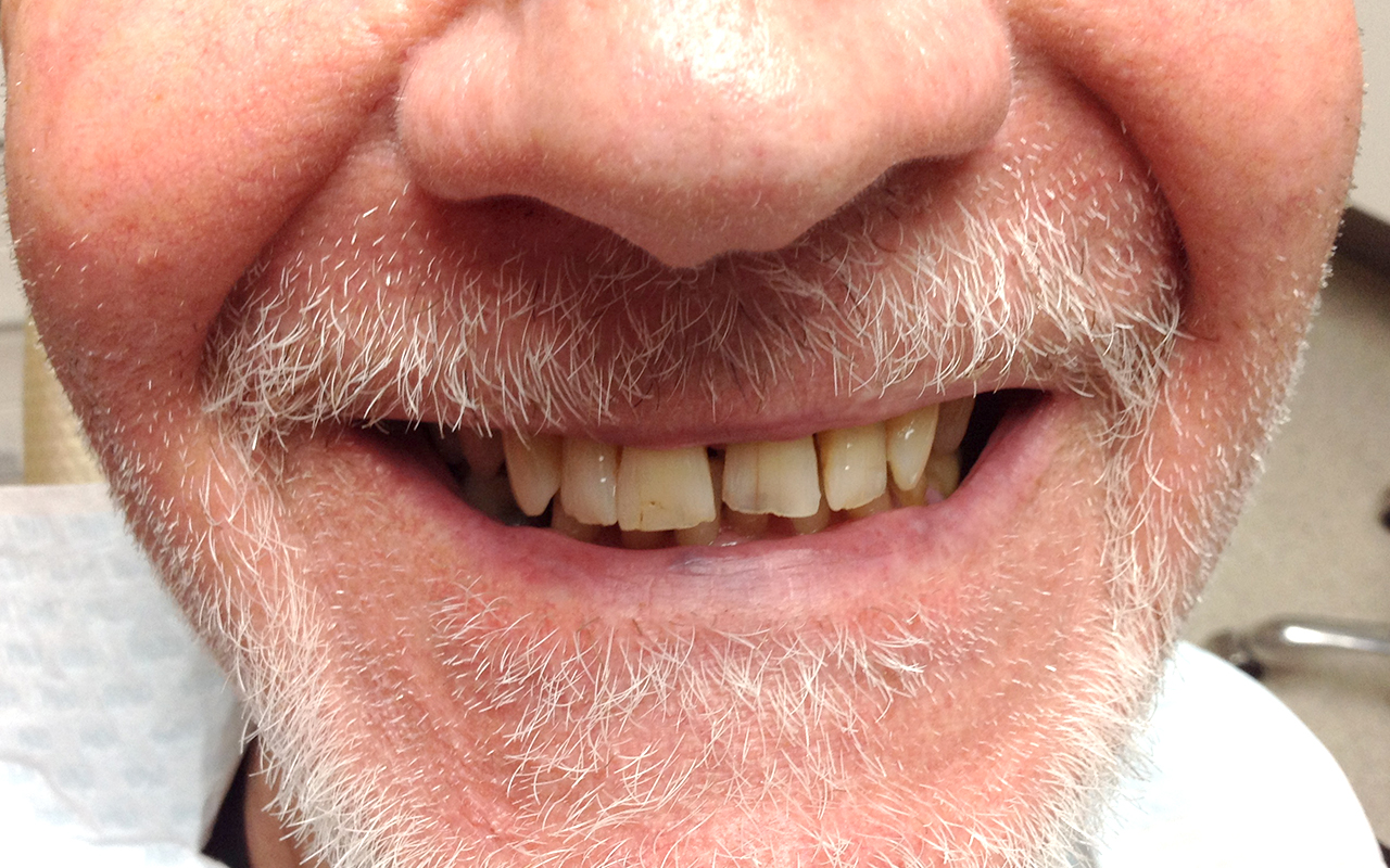 Full-arch restoration - before treatment