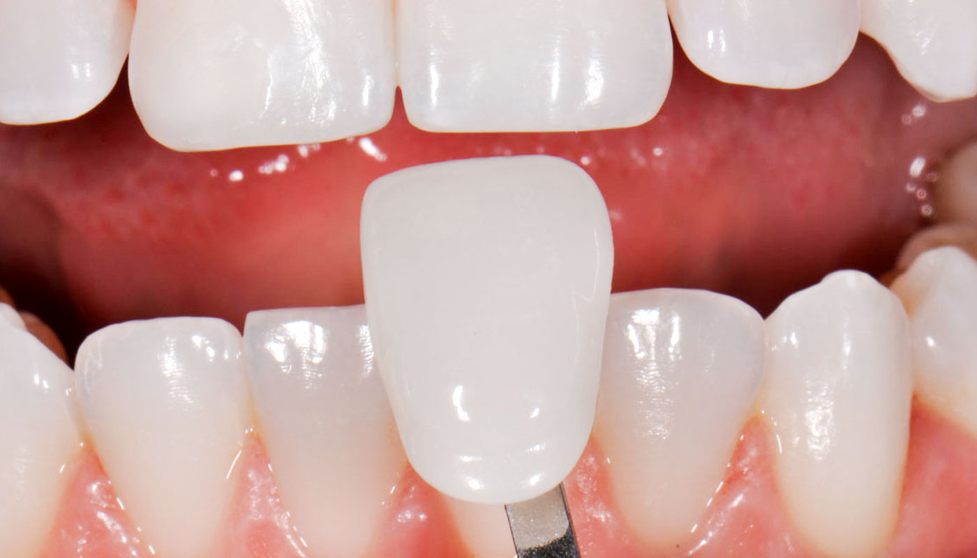 Crowns & veneers