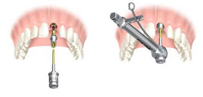 Placement of dental implantDental implantation in Budapest, Hungary