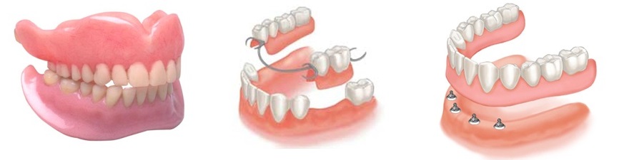 denture-dental-prosthesis-02