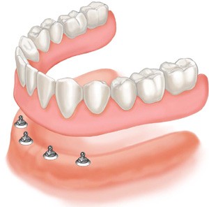 denture-dental-prosthesis-05